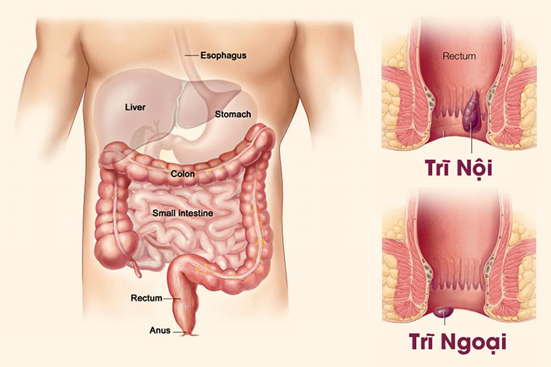 Trĩ nội hình thành phía trên đường lược trong ống hậu môn, trong khi trĩ ngoại xuất hiện phía dưới đường lược, gần rìa hậu môn.