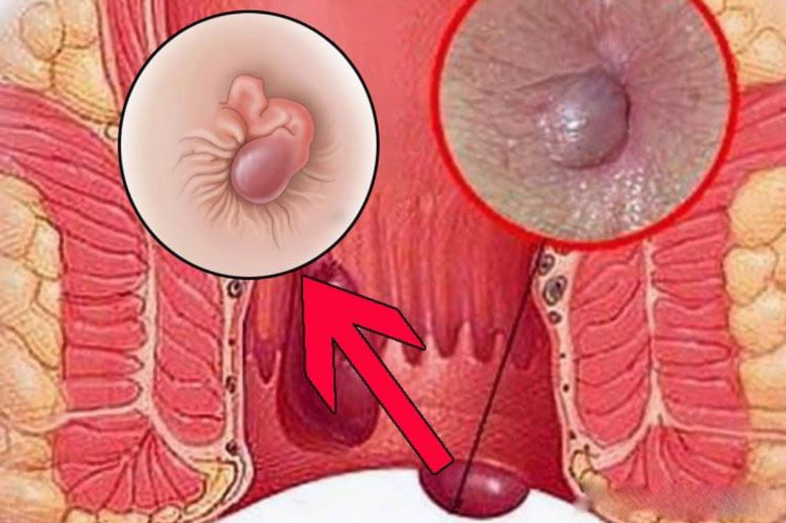 Búi trĩ sưng hoặc sa ra ngoài có thể gây đau rát, khó chịu và co thắt vùng hậu môn, đặc biệt khi đại tiện.