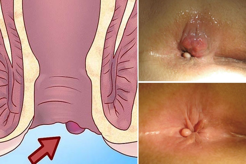 Biện pháp chữa trĩ tại nhà giúp xoa dịu cơn đau
