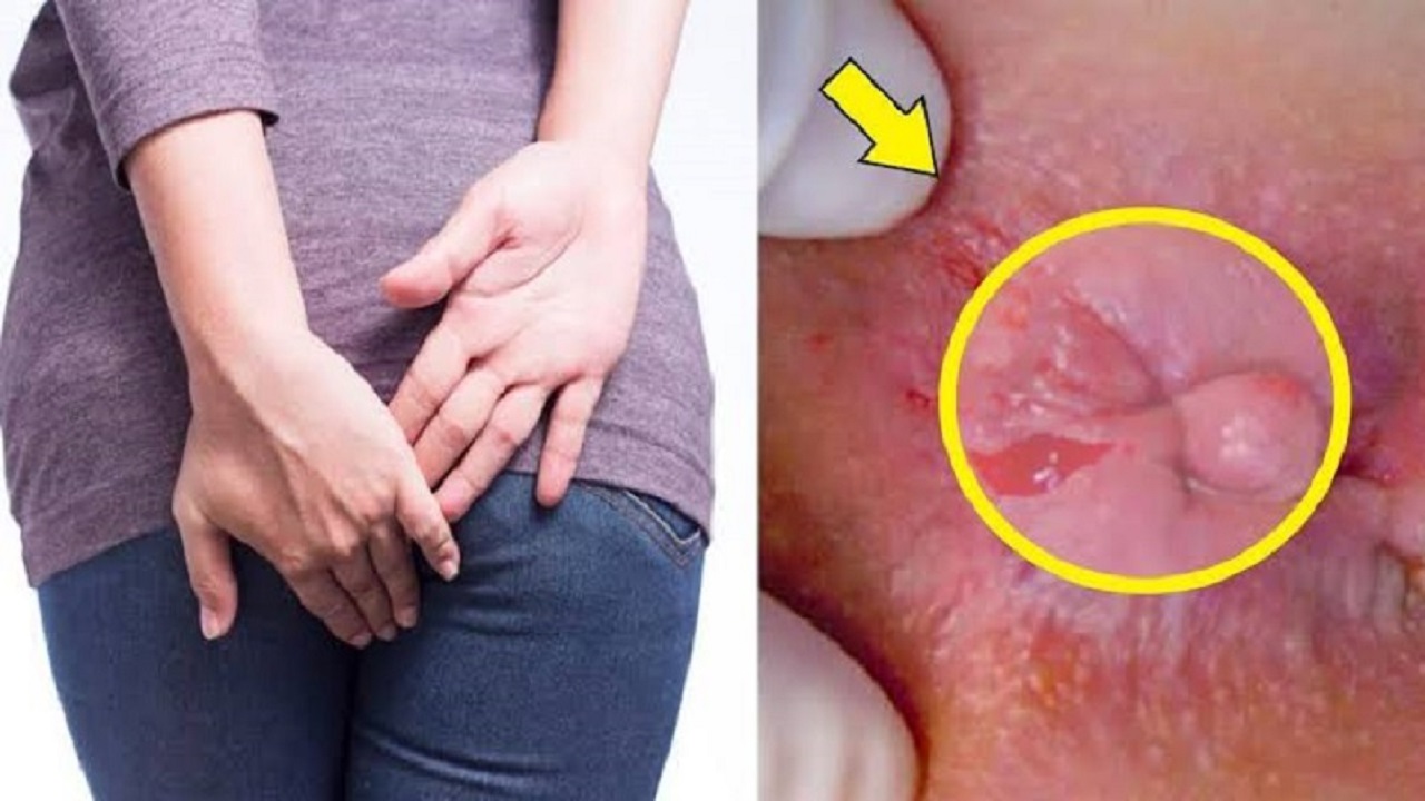 Búi trĩ có thể sa ra ngoài hậu môn, gây cộm vướng, khó chịu và đau, đặc biệt khi búi trĩ sưng viêm hoặc bị nghẹt.