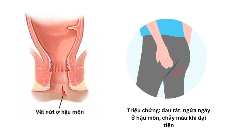 Nứt kẽ hậu môn thường gây đau rát khi đi ngoài, kích ứng vùng hậu môn và có thể xuất hiện máu đỏ tươi sau đại tiện.