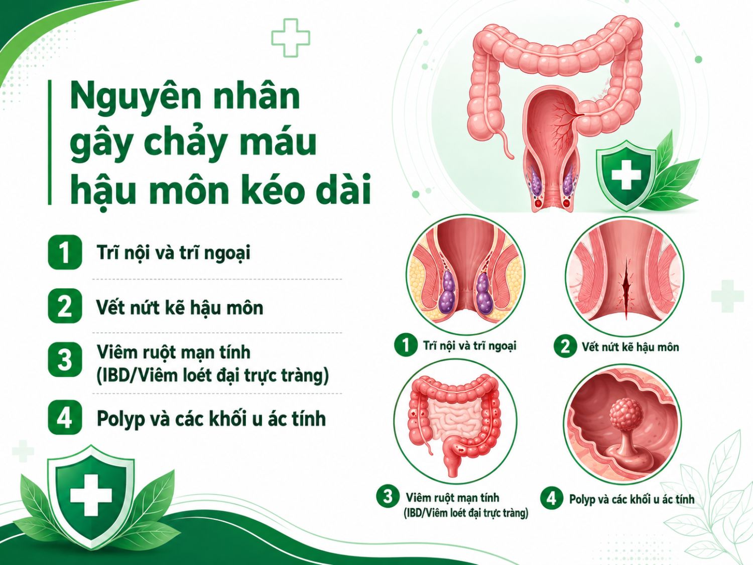 Chảy máu hậu môn kéo dài có thể là dấu hiệu của nhiều bệnh lý từ thường gặp như trĩ, nứt kẽ hậu môn đến các tình trạng nghiêm trọng hơn như viêm ruột mạn tính, polyp hoặc khối u ác tính. Người bệnh nên thăm khám sớm nếu triệu chứng lặp lại nhiều lần hoặc kéo dài.