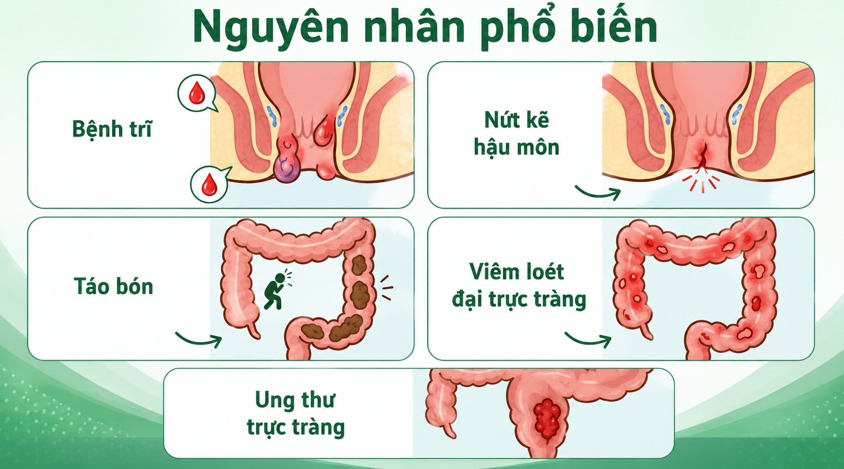 Đi ngoài ra máu kèm đau rát hậu môn có thể liên quan đến nhiều nguyên nhân như trĩ, nứt kẽ hậu môn, táo bón hoặc các bệnh lý đại trực tràng. Nếu triệu chứng kéo dài, tái diễn hoặc lượng máu tăng, người bệnh nên đi khám để xác định nguyên nhân.