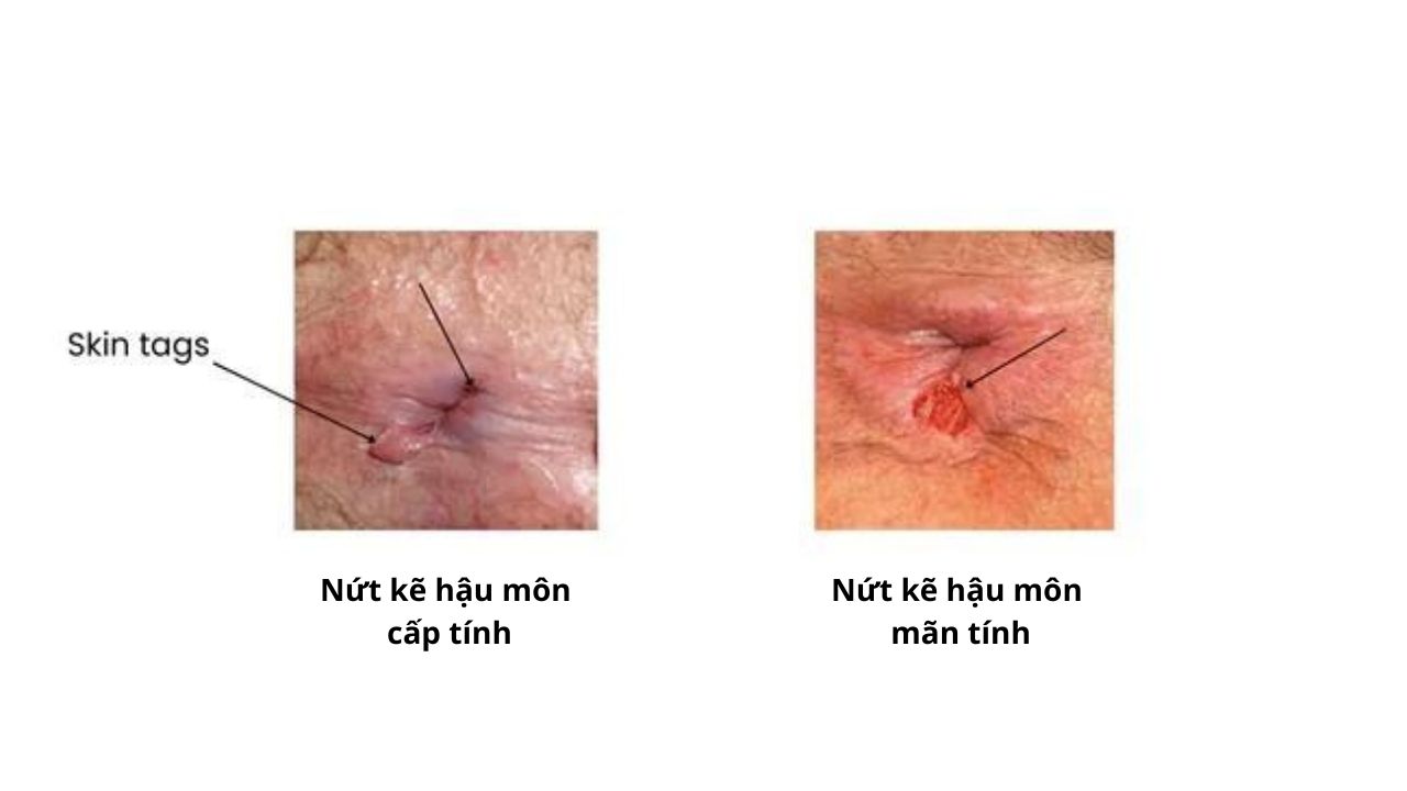 Nứt kẽ hậu môn có thể tiến triển từ giai đoạn cấp tính sang mạn tính nếu tổn thương kéo dài hoặc tái phát nhiều lần; trường hợp mạn tính có thể xuất hiện mô xơ hoặc mẩu da thừa quanh vết nứt.