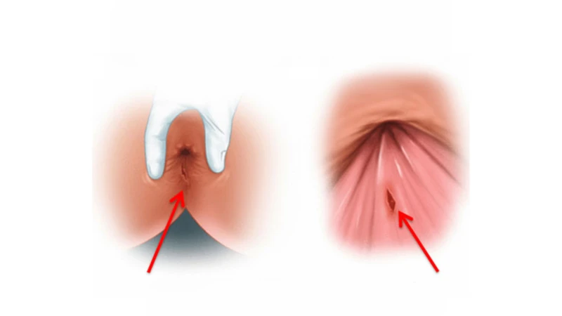 Nứt kẽ hậu côn có thể xuất hiện máu tươi khi đi ngoài