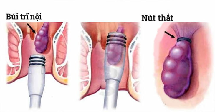 Kỹ thuật thắt vòng cao su được áp dụng cho một số trường hợp trĩ nội, giúp búi trĩ thiếu máu nuôi, teo dần và rụng sau điều trị.