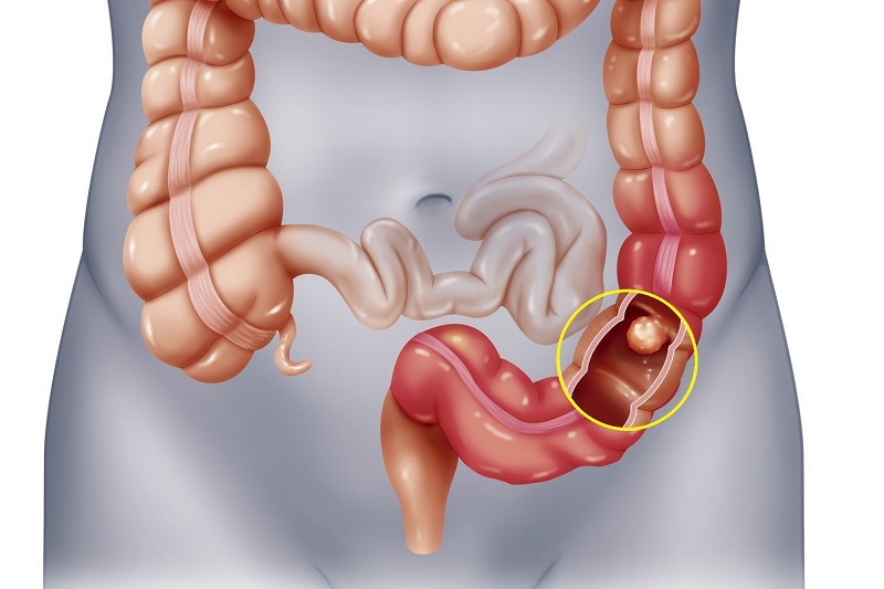 Một số bệnh có thể phát hiện khi nội soi đại tràng như viêm đại tràng