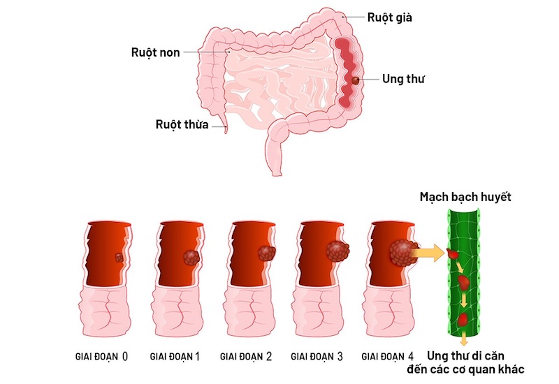 Ung thư đại tràng được chia thành nhiều giai đoạn dựa trên mức độ xâm lấn của khối u, tình trạng hạch bạch huyết và di căn xa. Giai đoạn bệnh là yếu tố quan trọng để bác sĩ lựa chọn phương pháp điều trị và đánh giá tiên lượng.