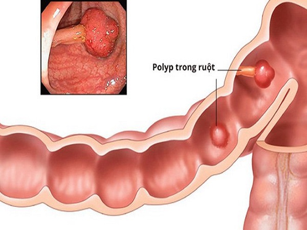 Trường hợp cắt polyp đại tràng chi phí sẽ phát sinh cao hơn