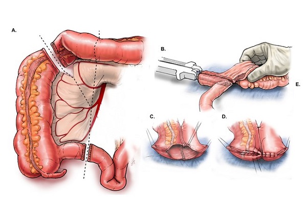 Phẫu thuật là phương pháp điều trị quan trọng ở nhiều trường hợp ung thư đại tràng, thường bao gồm cắt bỏ đoạn ruột chứa khối u cùng mô và hạch liên quan, sau đó tái lập lưu thông đường tiêu hóa.