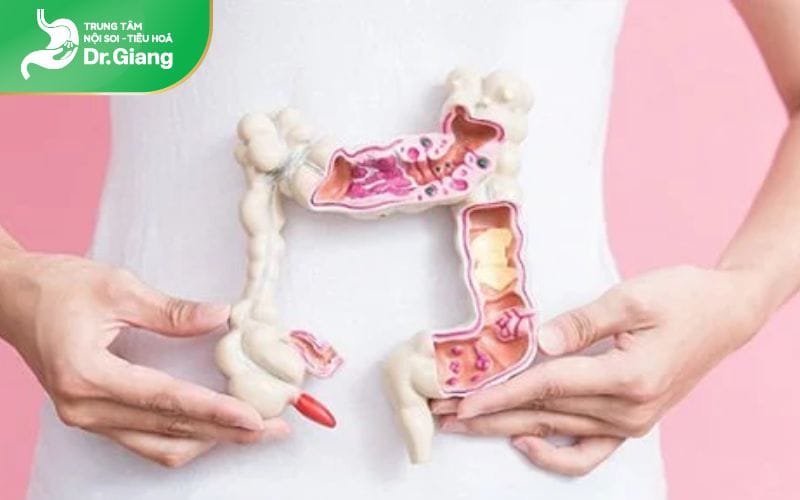 Chuẩn bị kỹ trước khi nội soi đại tràng sẽ đảm bảo kết quả chính xác