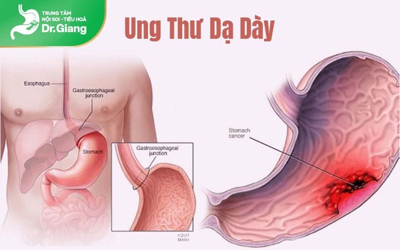 Nội soi dạ dày phù hợp với người muốn tầm soát ung thư dạ dày