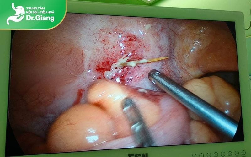 Nội soi dạ dày có thể phát hiện dị vật trong đường tiêu hoá