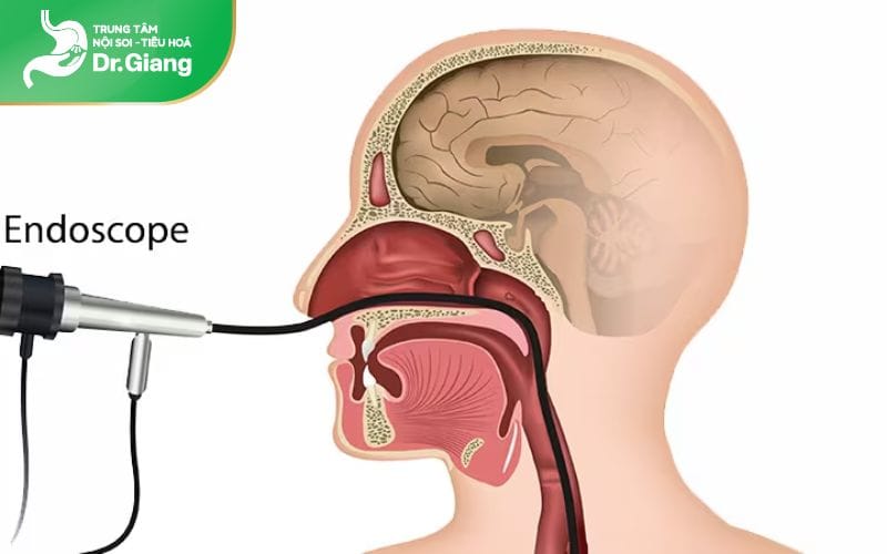 Nội soi dạ dày đường mũi không gây phản xạ nôn do không luồn ống nội soi qua vòm họng, lưỡi gà