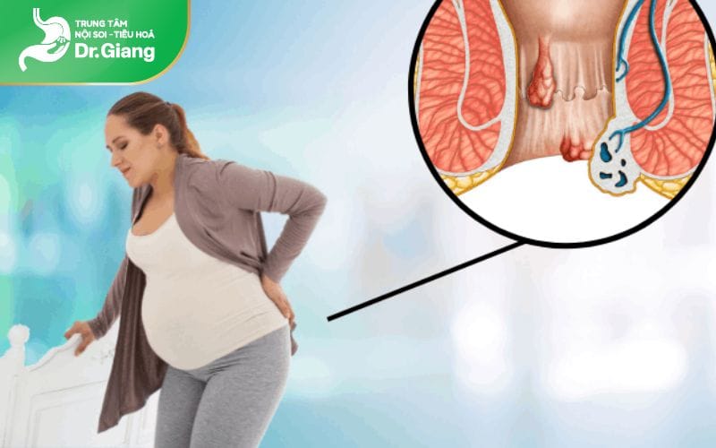 Phụ nữ mang thai dễ mắc trĩ
