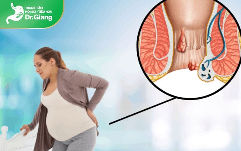 Phụ nữ mang thai dễ bị trĩ