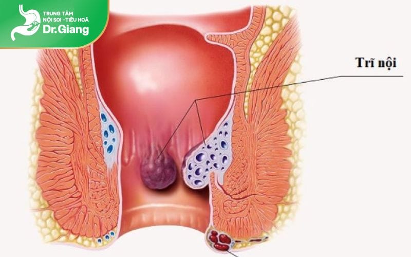 Hình ảnh bệnh trĩ nội