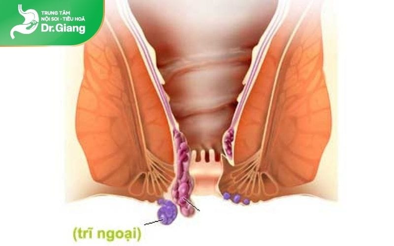 Trĩ ngoại là tình trạng sưng tĩnh mạch bên ngoài hậu môn