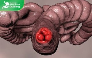 Bệnh trĩ ngoại là gì? Phương pháp điều trị bệnh trĩ ngoại