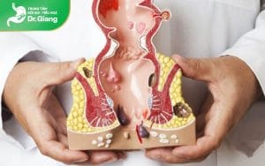 Nguyên nhân, dấu hiệu và cách điều trị bệnh trĩ nội hiệu quả