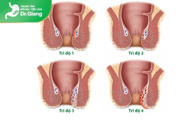 Mức độ nghiêm trọng của bệnh trĩ ảnh hưởng đến chi phí