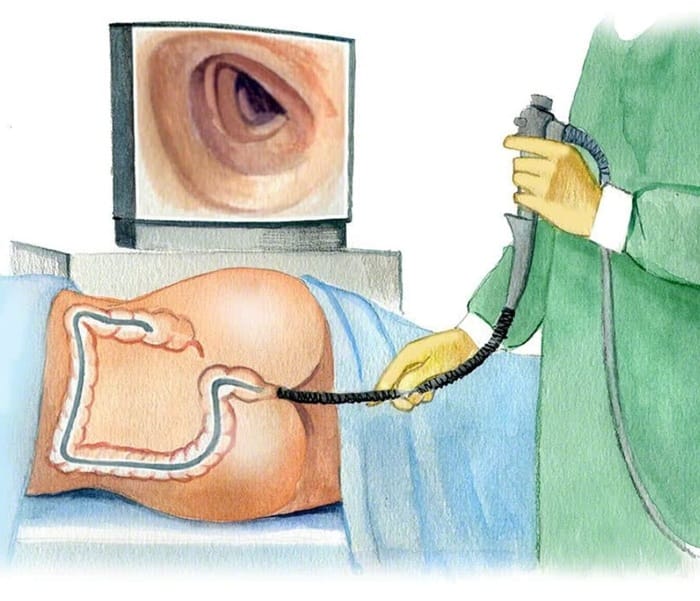 Quy trình cắt polyp đại tràng bằng nội soi 5 bước chuẩn Y khoa