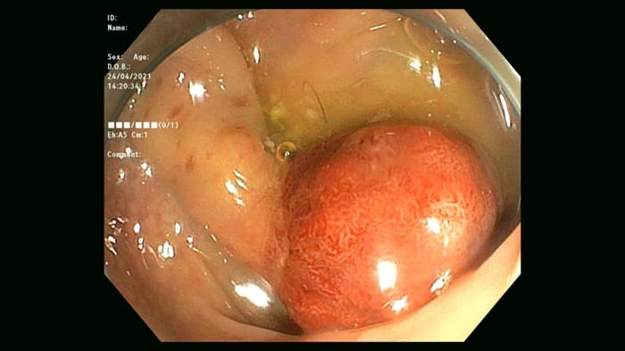 Nên cắt polyp đại tràng có kích thước lớn