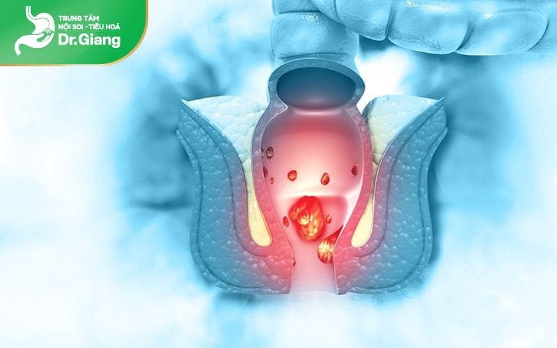 Cắt trĩ bằng phương pháp Milligan Morgan