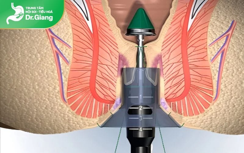 Phương pháp cắt trĩ PPH