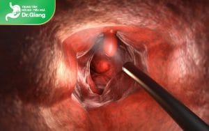 Nội soi trực tràng là gì? Quy trình nội soi trực tràng chi tiết