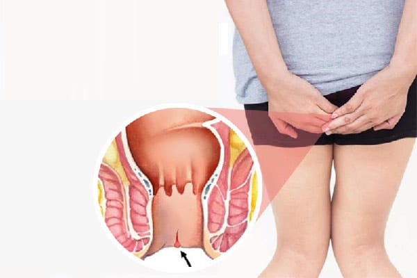 Có thể lành vết nứt kẽ hậu môn nếu vết nứt nhỏ 