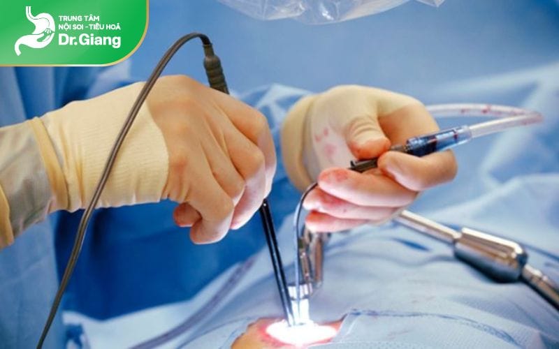 Phương pháp cắt trĩ được thực hiện bởi các bác sĩ chuyên khoa