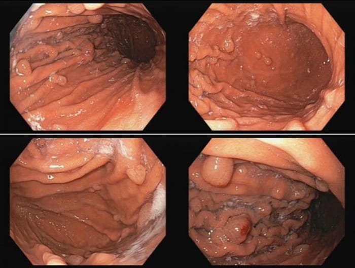 Polyp dạ day có rất nhiều loại