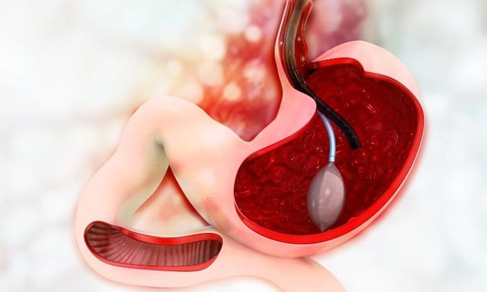  Mức độ nguy hiểm phụ thuộc vào loại polyp