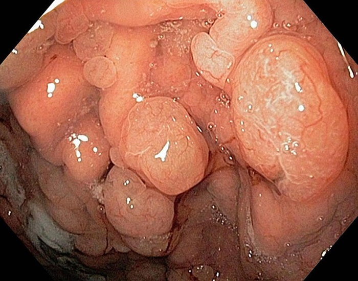 Polyp dạ dày không cuống có nguy cơ tiến triển thành ung thư cao