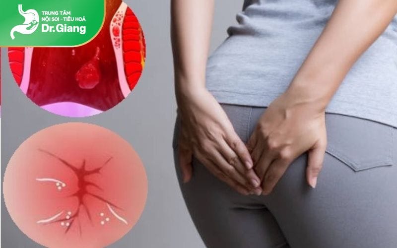 Xuất hiện các cục nhỏ, mềm tại vùng hậu môn