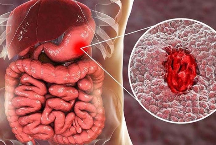 Người bị xuất huyết dạ dày