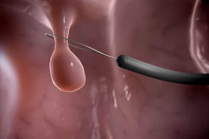 Tùy thuộc vào kích thước và số lượng polyp mà thời gian hồi phục là khác nhau