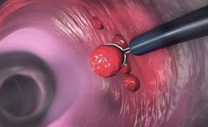 Cắt polyp dạ dày không nguy hiểm khi thực hiện bằng nội soi