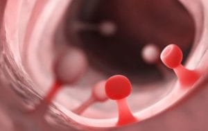 Nhiều polyp và có kích thước lớn cần cắt càng sớm càng tốt