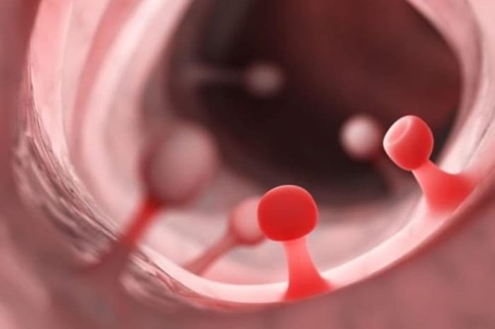 Số lượng polyp ảnh hưởng tới chi phí cắt polyp dạ dày