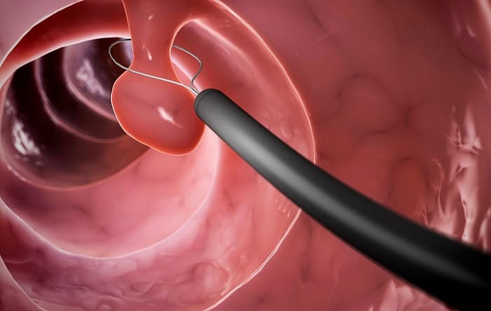 Kích thước polyp cũng ảnh hưởng tới chi phí cắt polyp hậu môn