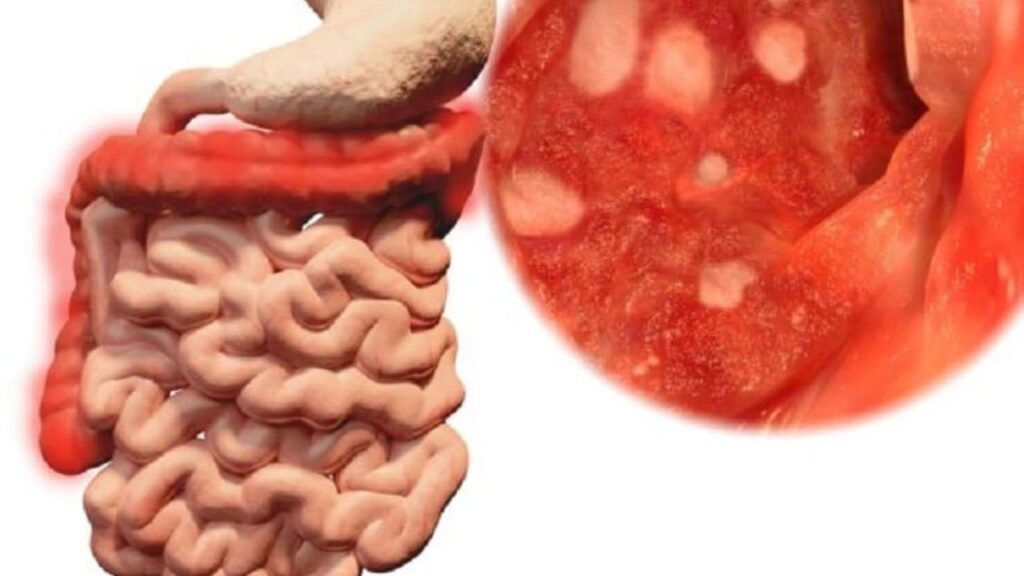 5 Dấu hiệu cần đi khám đại tràng ngay