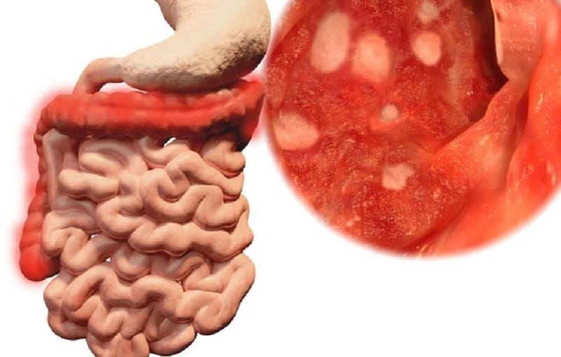 Bệnh lý đại tràng cần được thăm khám và điều trị kịp thời