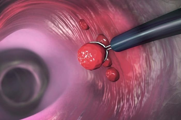 Khám polyp dạ dày tại viện E