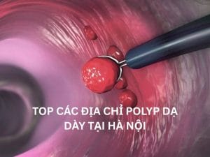 Địa chỉ polyp dạ dày tại Hà Nội? Gợi ý 6 địa chỉ uy tín