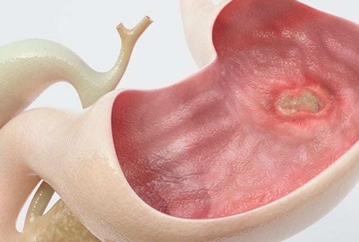 Thời gian chữa loét dạ dày khác nhau tùy tình trạng