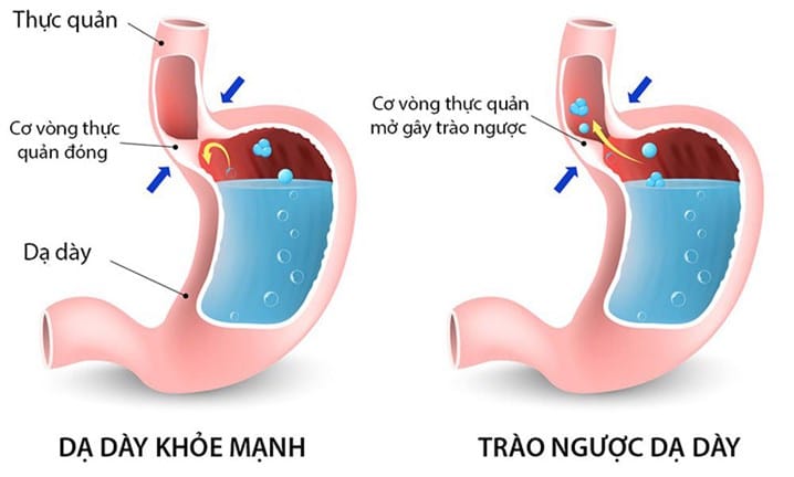 Khi ăn uống không khoa học có thể gây trào ngược dạ dày