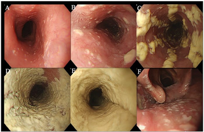 Hình ảnh trào ngược dạ dày qua nội soi có thể phát hiện sớm các bệnh lý