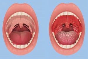 Hình ảnh viêm họng do trào ngược dạ dày